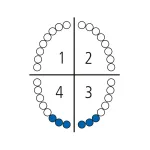 Щипцы для удаления нижних зубов 140-33A Schwert